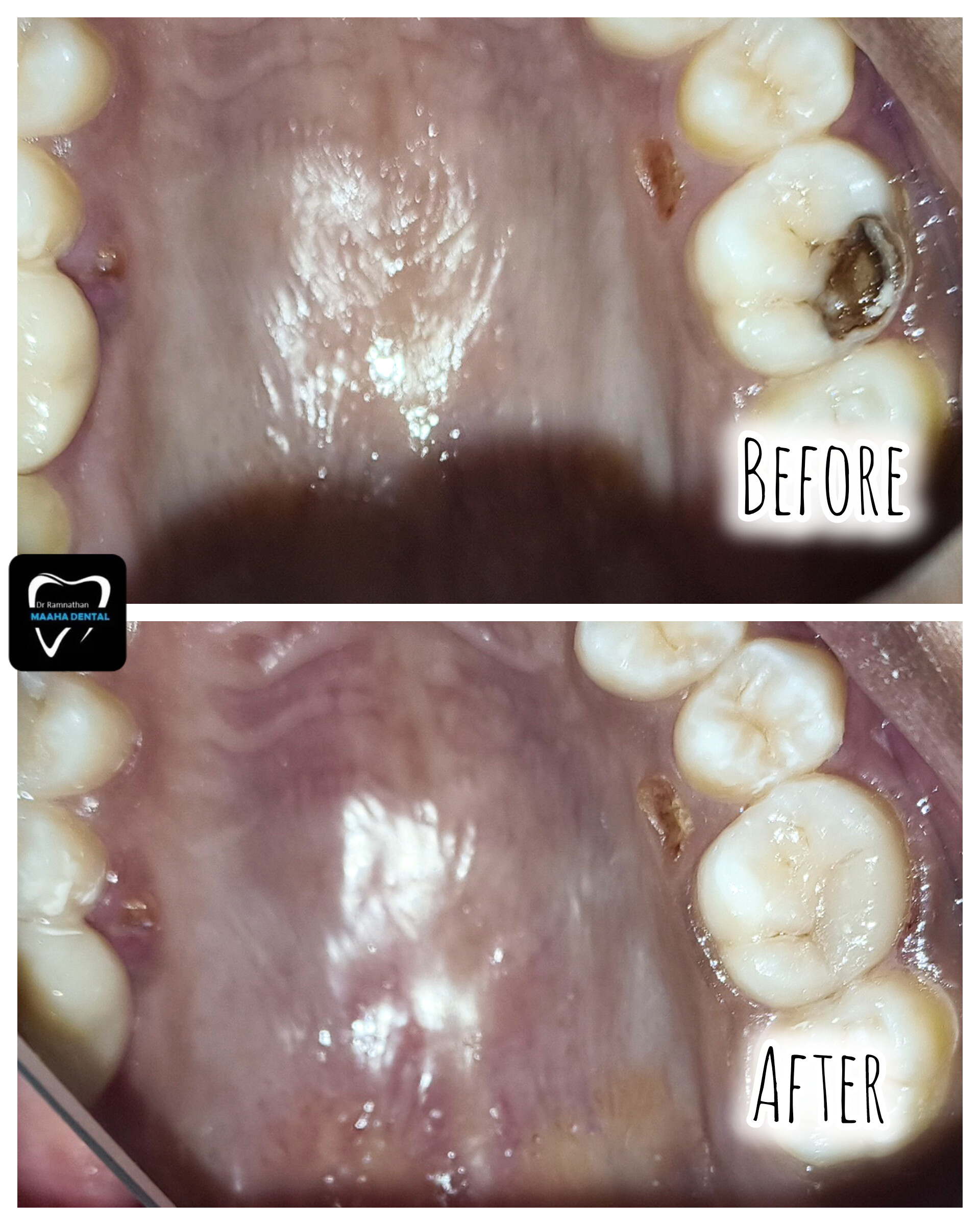 Dental Restoration